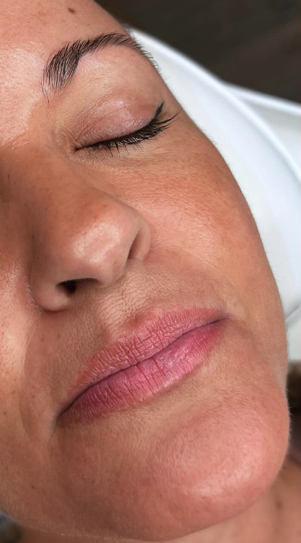 Eliminar codigo de barras en labios en Madrid