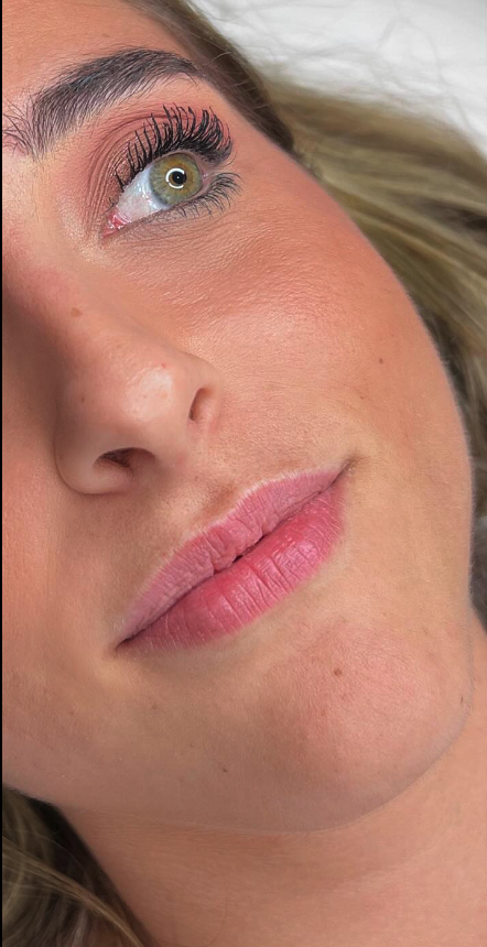 Relleno de surco nasogeniano en Madrid