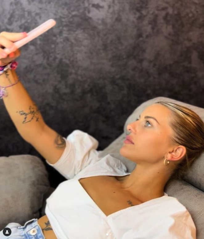 Acido hialurónico en menton Madrid