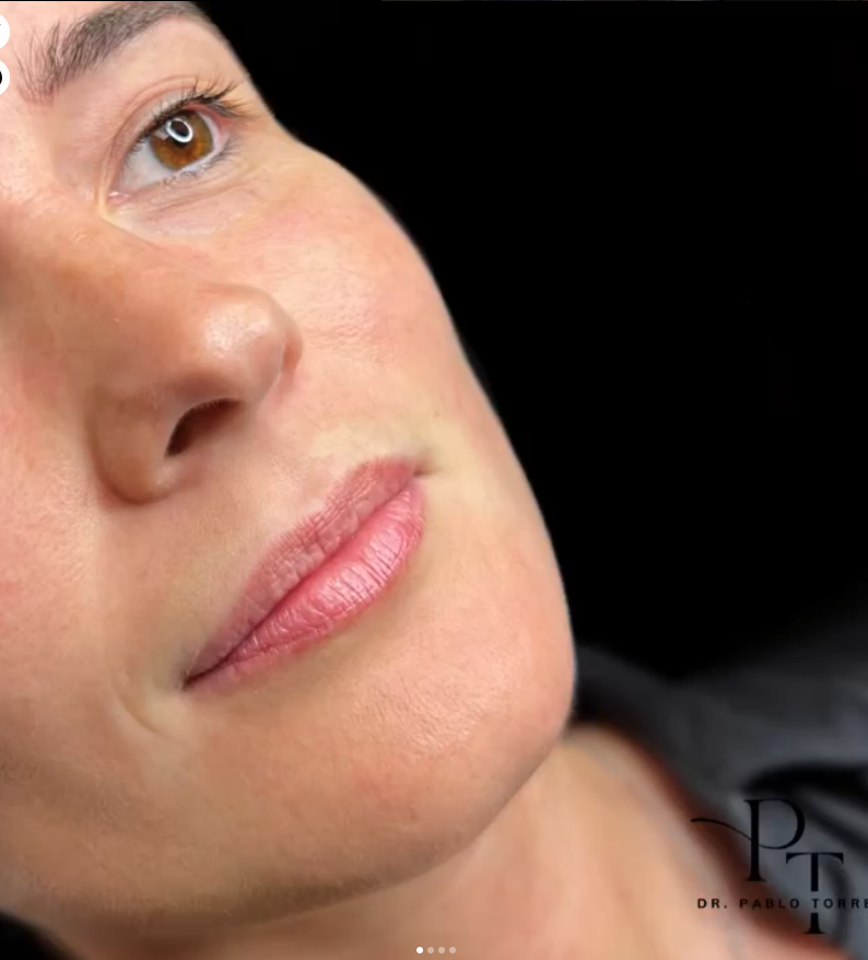 Eliminar codigo de barras en labios en Madrid