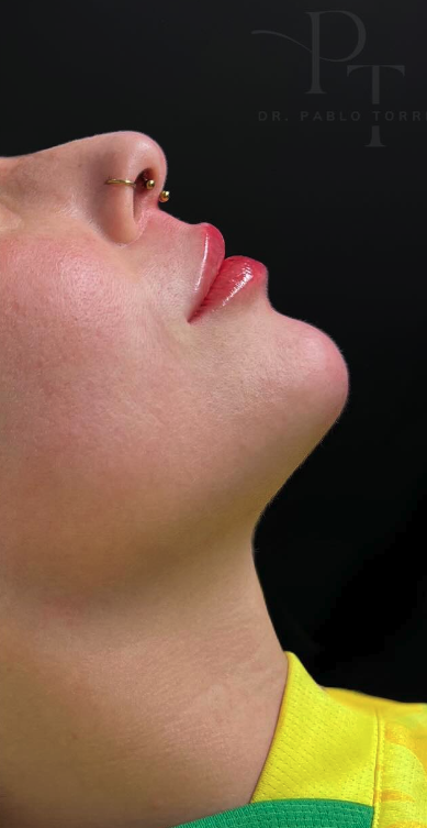 sonrisa gingivinal tratamiento