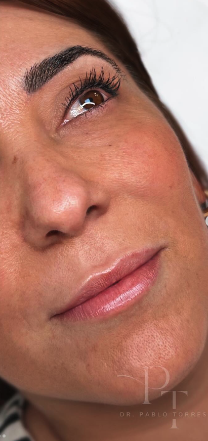 Relleno de surco nasogeniano en Madrid