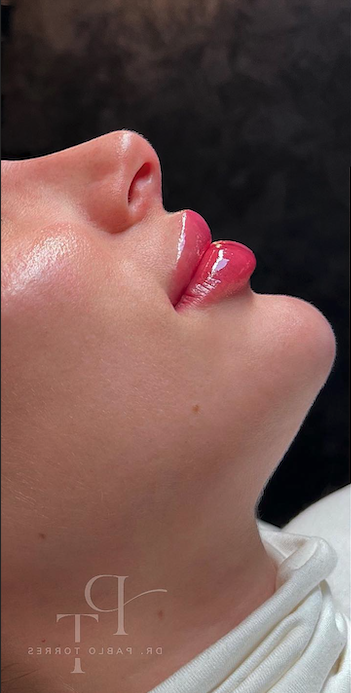 Acido hialurónico en menton Madrid