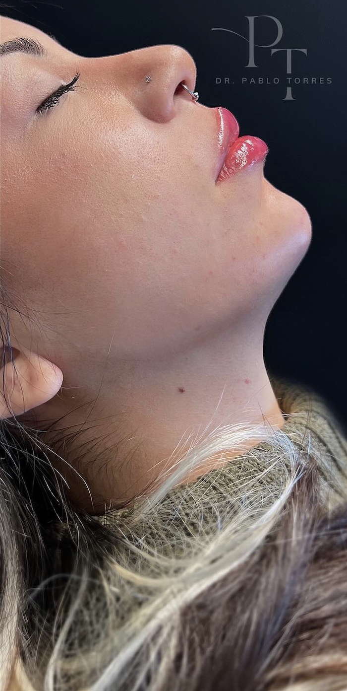 Acido hialurónico en menton Madrid